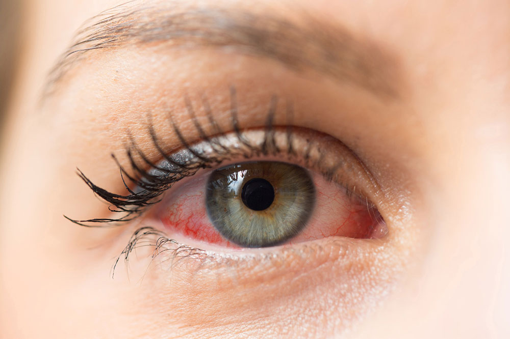 4 Homely Remedies for Dry Eyes